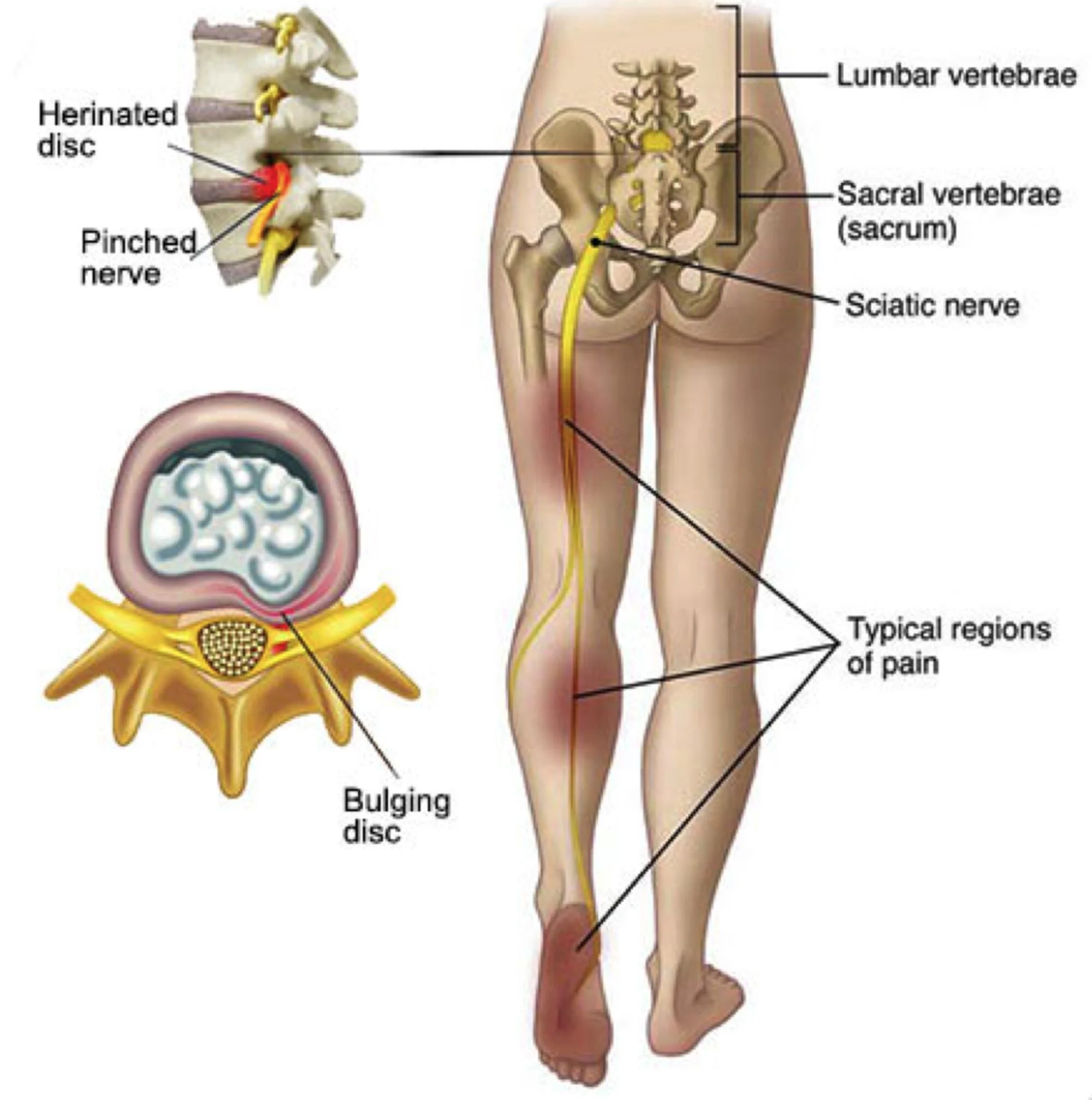 Graphic of a person's lower half with overlaid anatomy of the lumbopelvic region in relation to potential causes of sciatica.