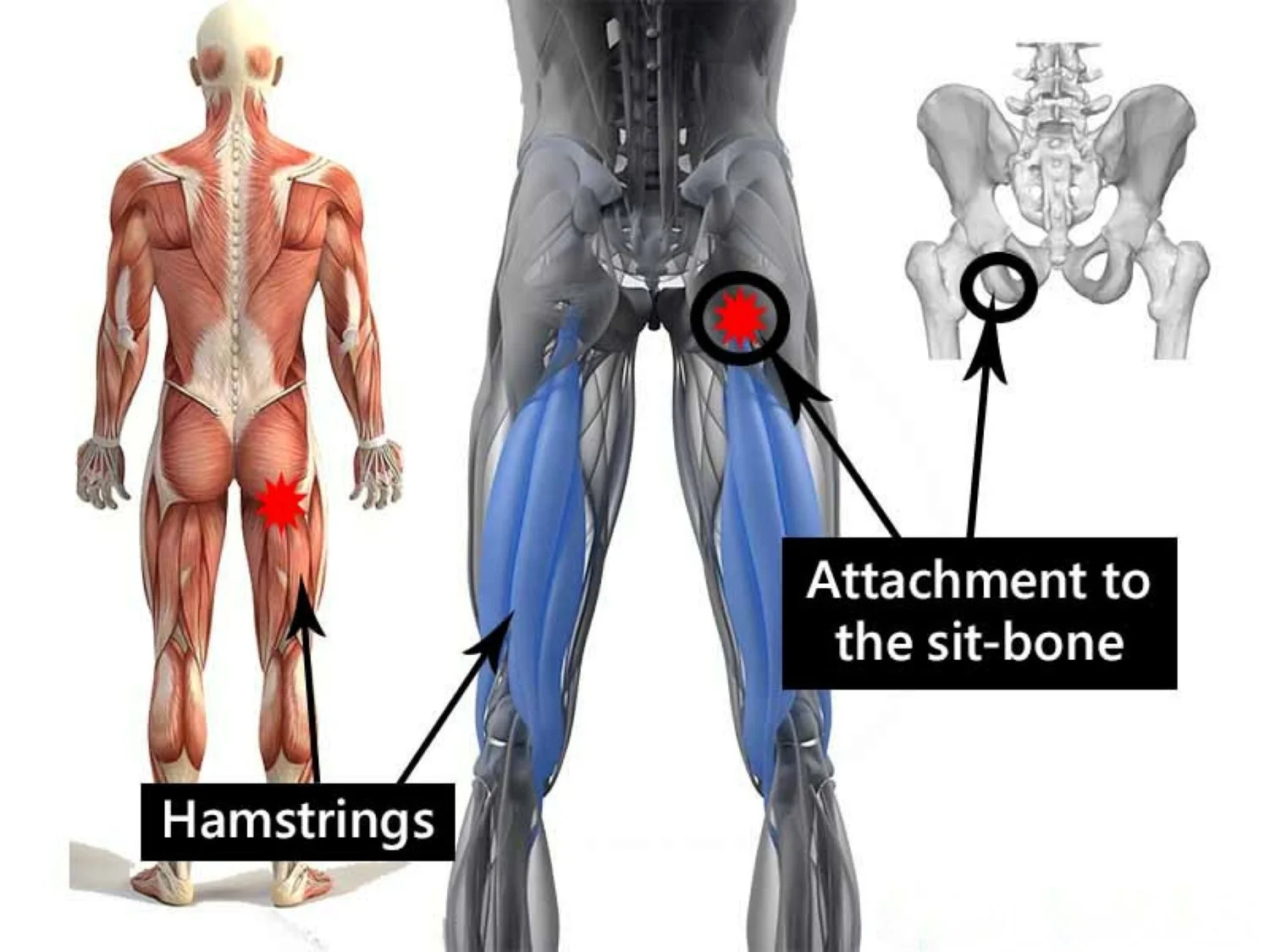 A graphic of a human's posterior chain, namely the hamstring and high-hamstring tendinopathy (HHT)