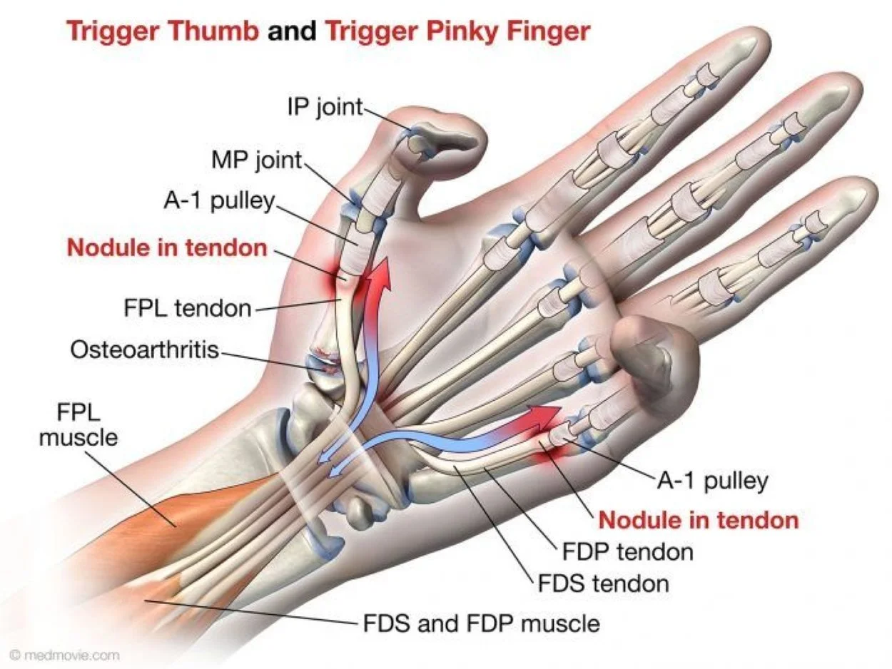 Diagram of trigger finger and trigger thumb along with the anatomy.