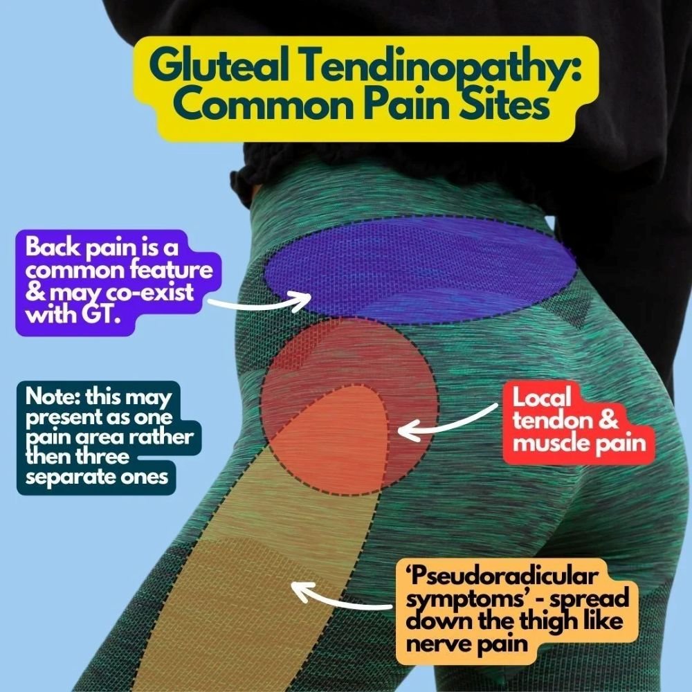 Image of a woman's hip with overlaid text about common pain sites of gluteal tendonitis