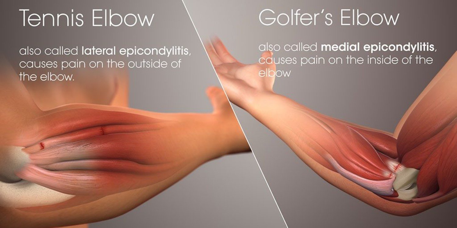 Infographic differentiating tennis and golfer's elbow pain