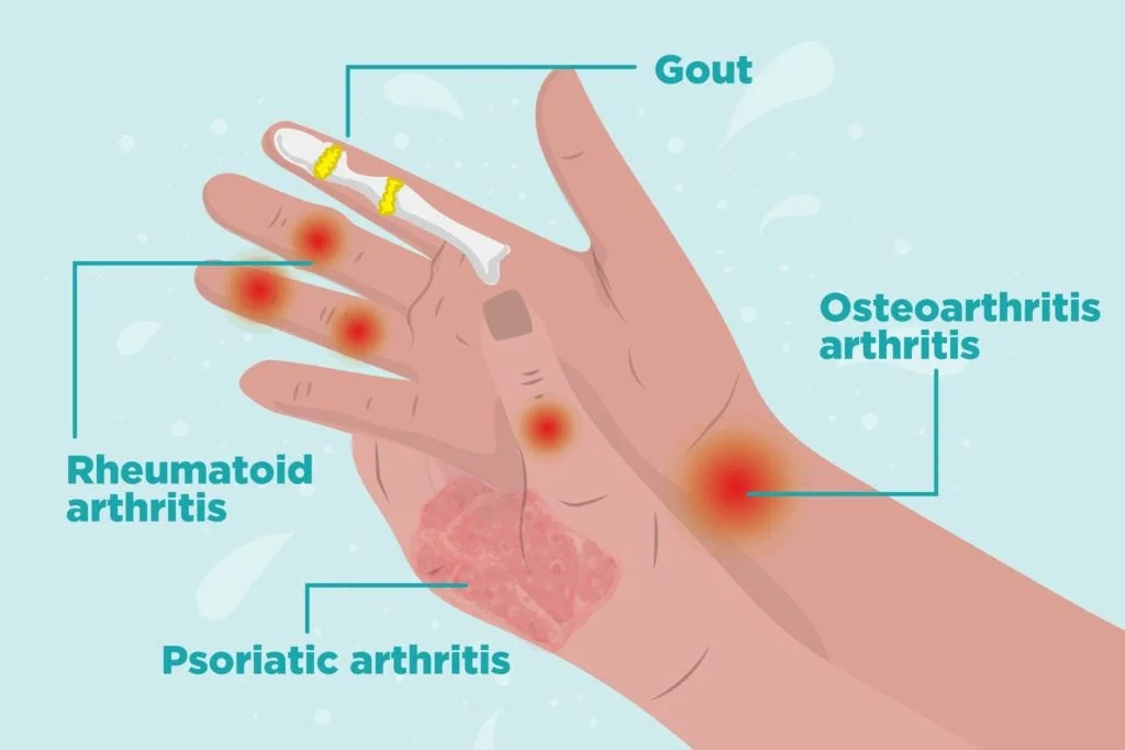 Graphic of wrist and hand arthritis pain