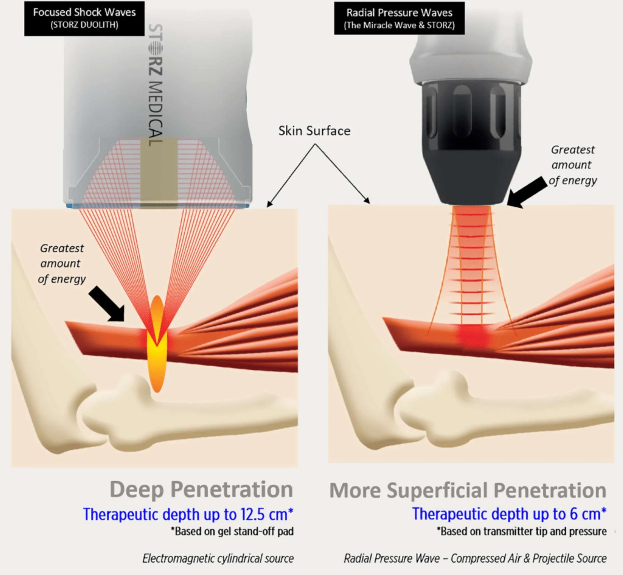 An infographic demonstrating the difference between focused and radial shockwave therapy.