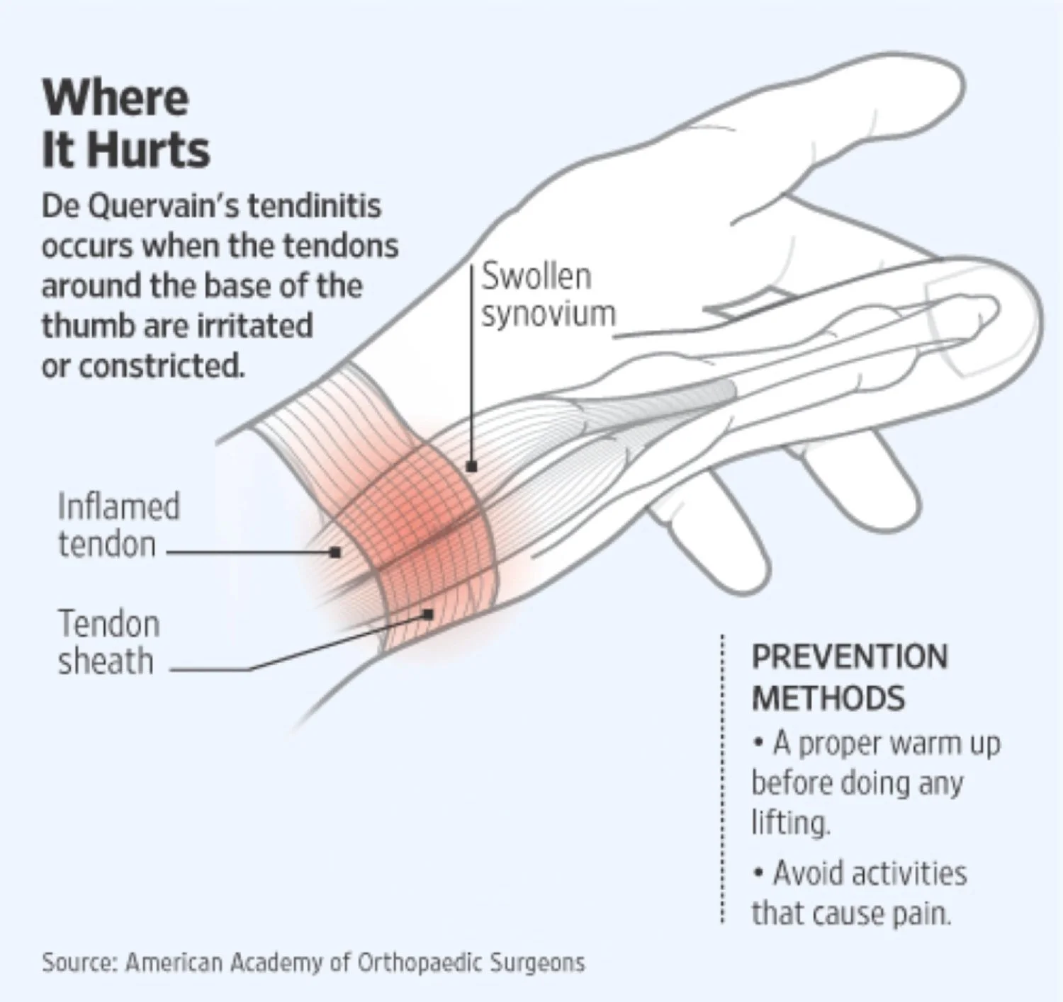 De Quervain's causes pain in the tendons as the base of the thumb due to constriction or irritation.