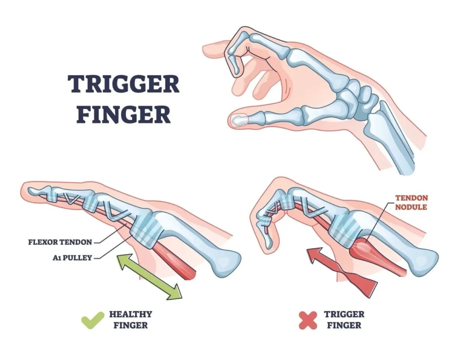 illustration of a healthy finger and trigger finger.