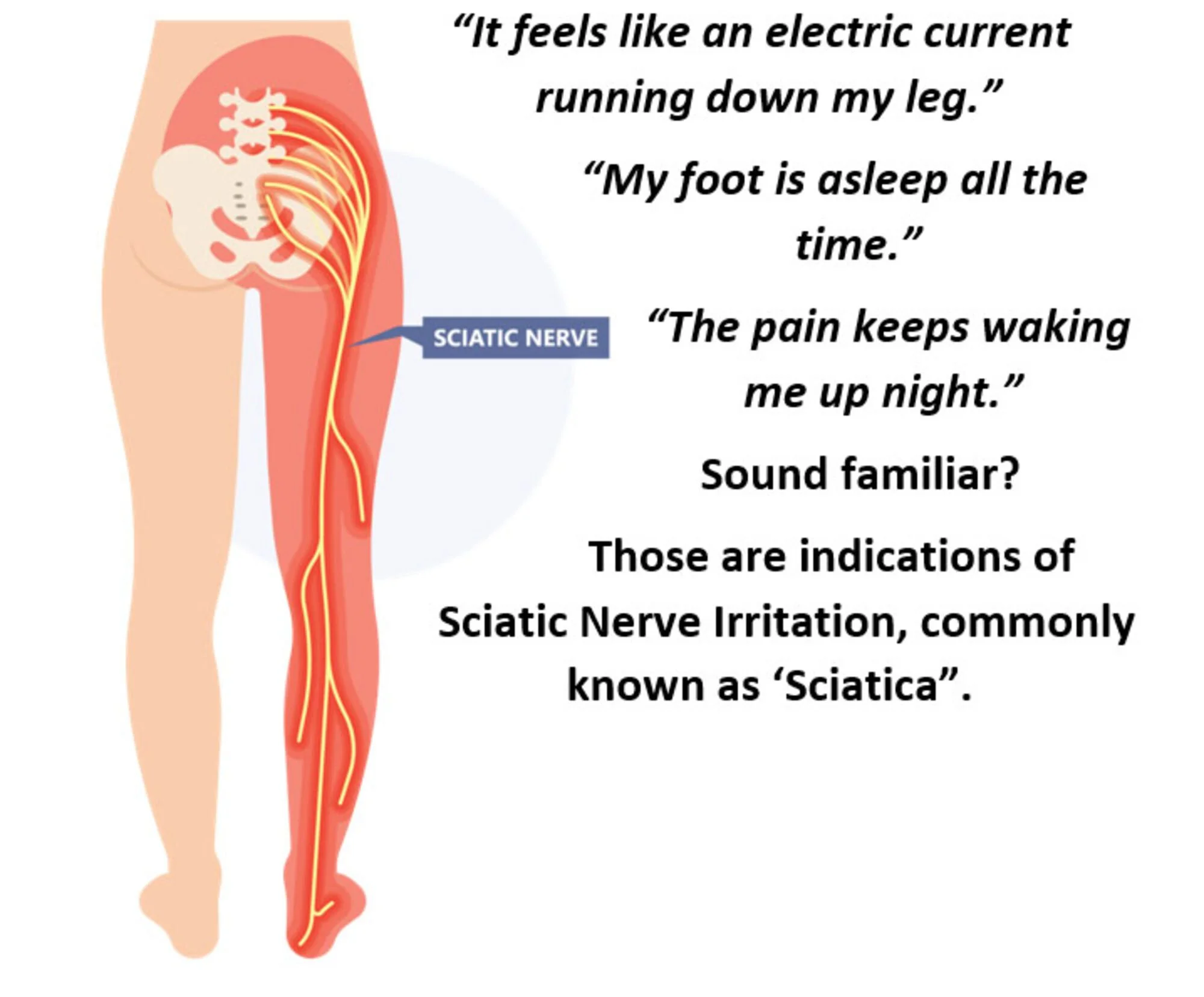 Infographic of quotes from patients describing what sciatica and radiating leg pain feels like