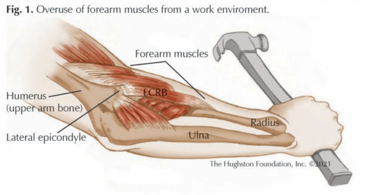 A figure demonstrating the anatomy of lateral epicondylitis and how it is caused by overuse