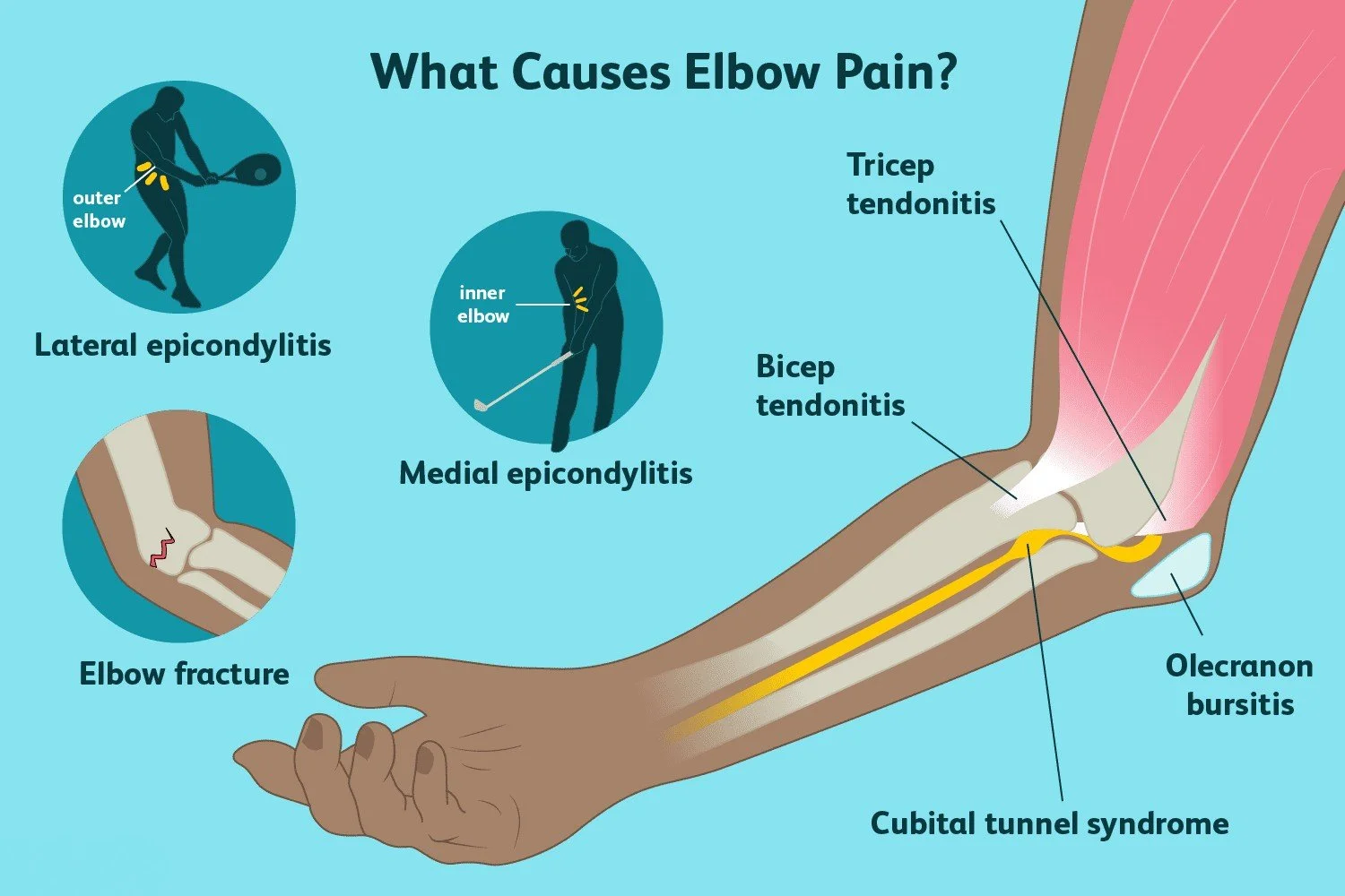 Infographic about various elbow pain diagnoses