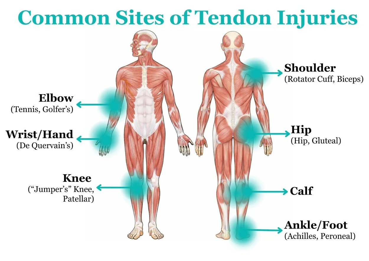 Common tendon injury sites. Tendinopathy recovery in Hillsboro, OR