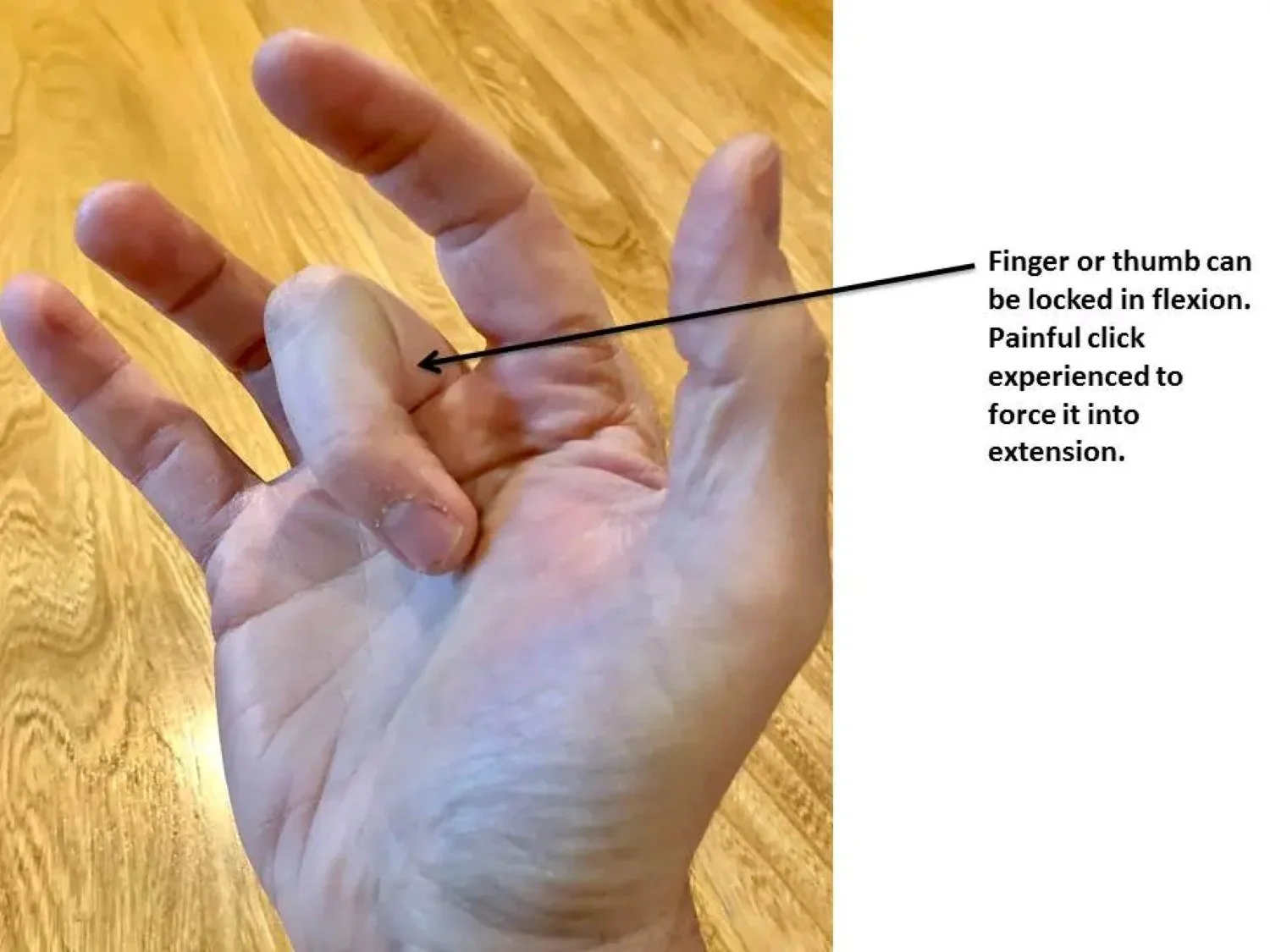 Image of someone's hand demonstrating what trigger finger would look like