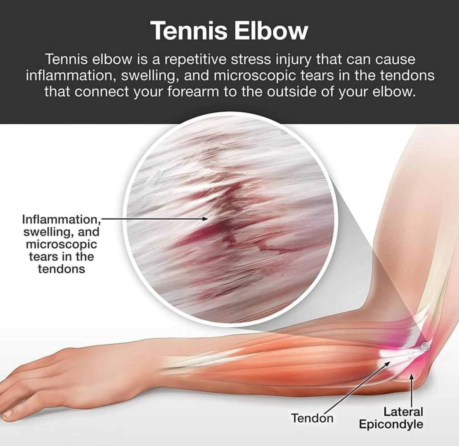 Diagram about tennis elbow aka lateral epicondylitis