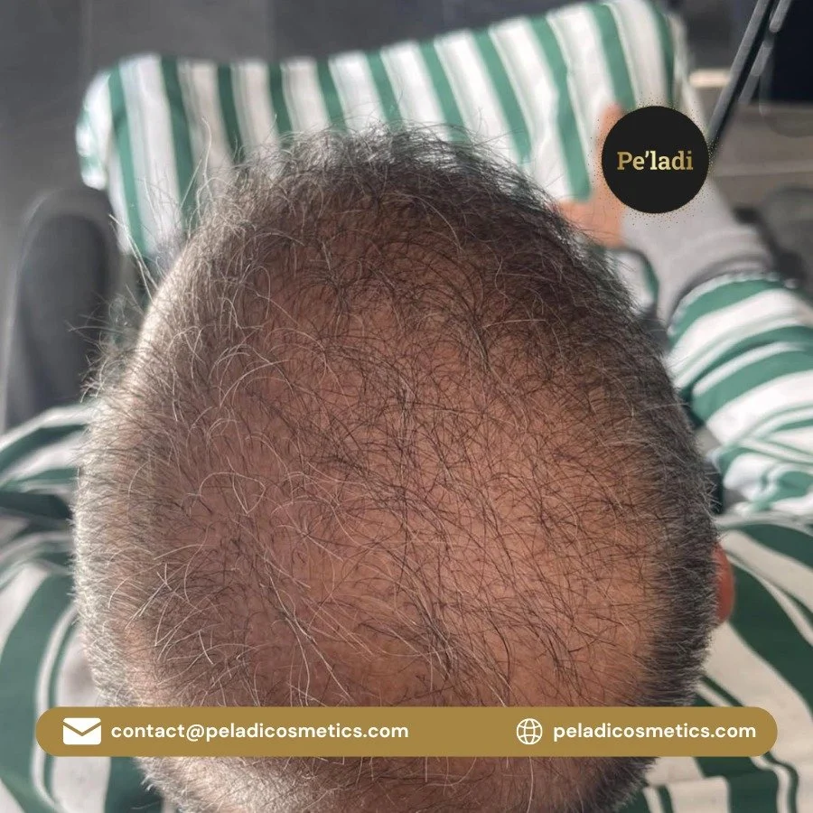 When it comes to your scalp, experience matters.

With two decades of cosmetic tattoo expertise, we&rsquo;ve helped countless clients in Sydney transform their confidence with precision, care, and artistry.

We don&rsquo;t just perform SMP &mdash; we