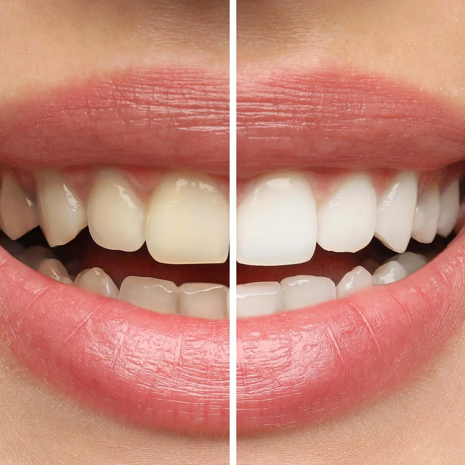 Professional Teeth Whitening vs At-Home Kits