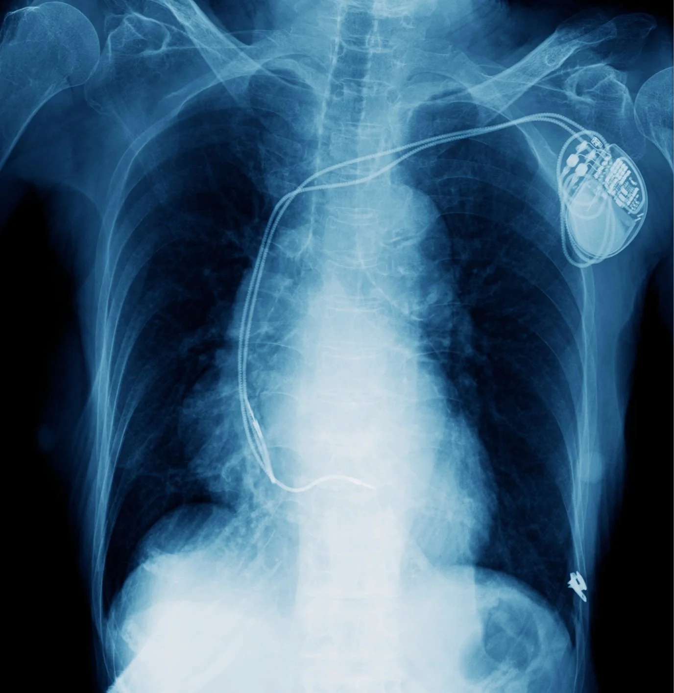Pacemaker Implant & Management | Heart Device Care in Hawaii Hawaii ...
