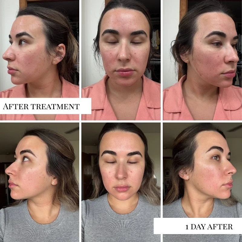 From post-treatment redness to a radiant
glow ✨
Scroll through to see how microneedling
with PRF transforms the skin by boosting
collagen, smoothing texture, and leaving it
refreshed + glowing.
💫
#PRF #Microneedling