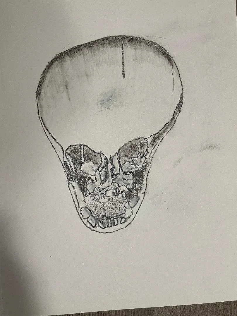 Harlequin sign - bilateral