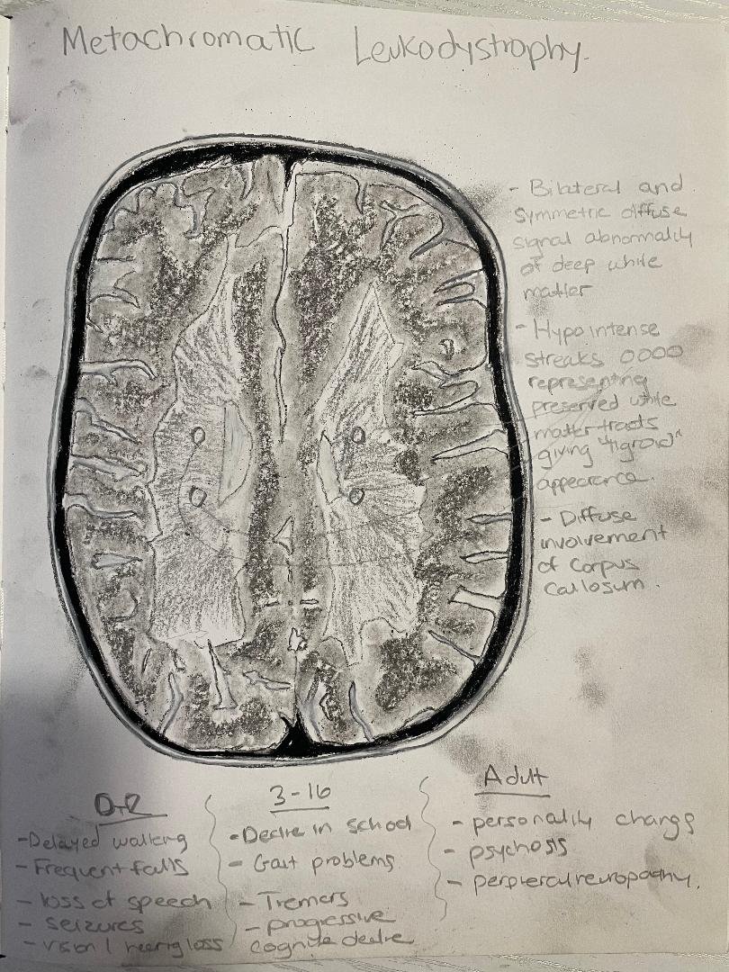 Metachromatic leukodystrophy