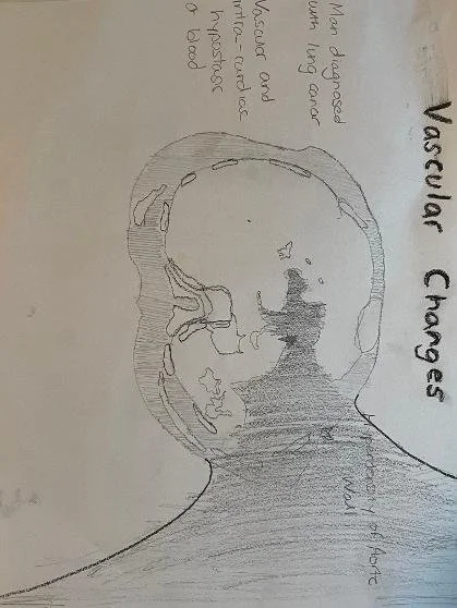 Vascular changes