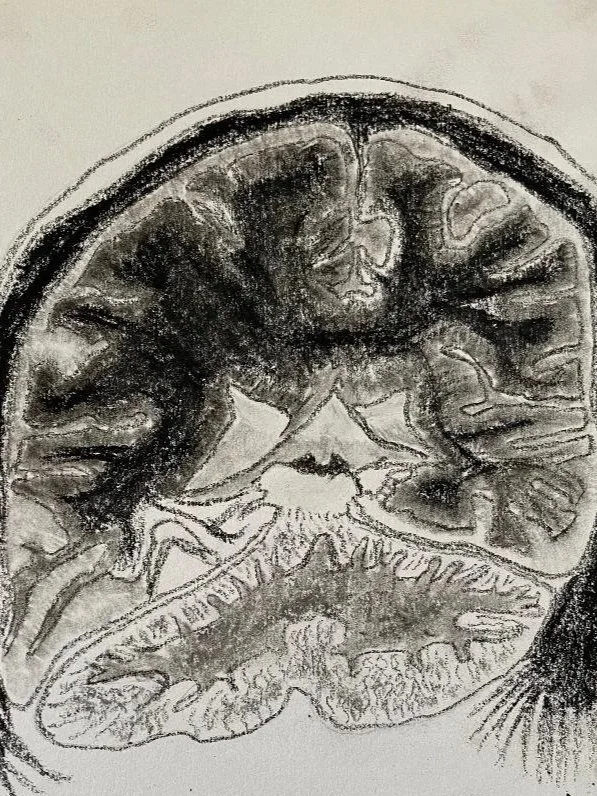 Temporal encephalocele into the transverse sinus