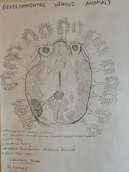 Developmental venous anomaly