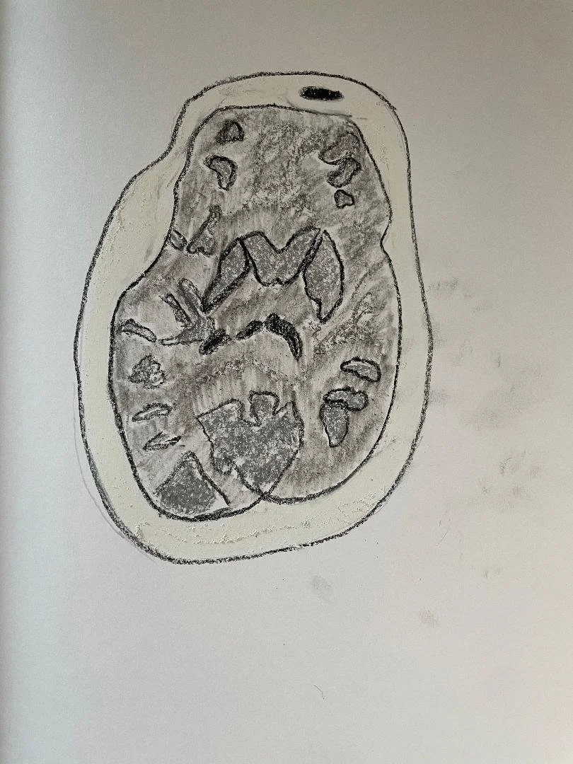 Adult hypoxic-ischemic encephalopathy
