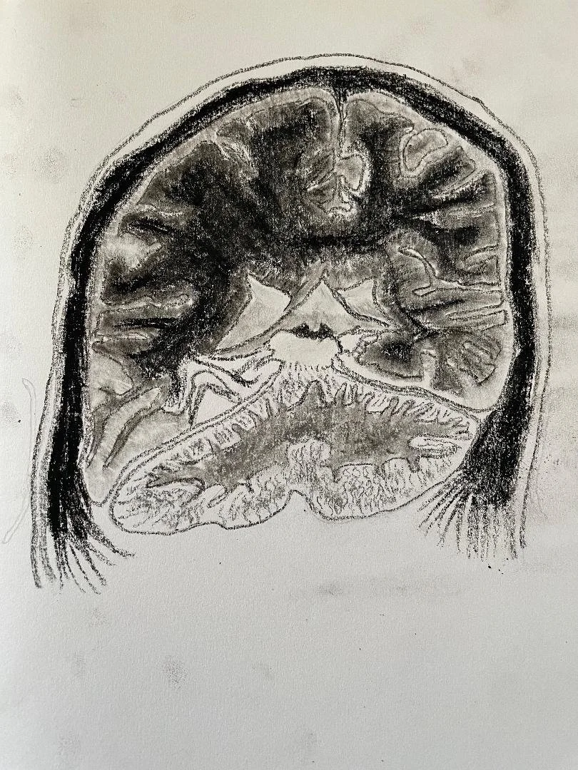 Temporal encephalocele into the transverse sinus