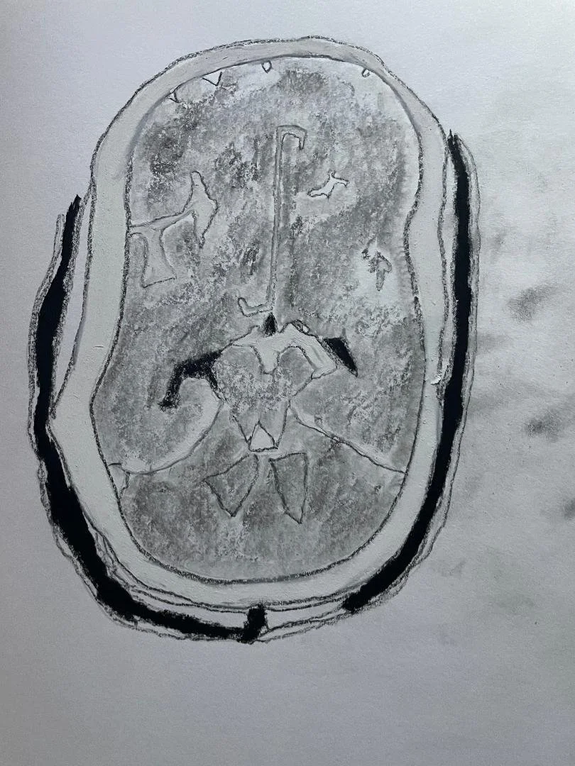 Subarachnoid haemorrhage - aneurysmal