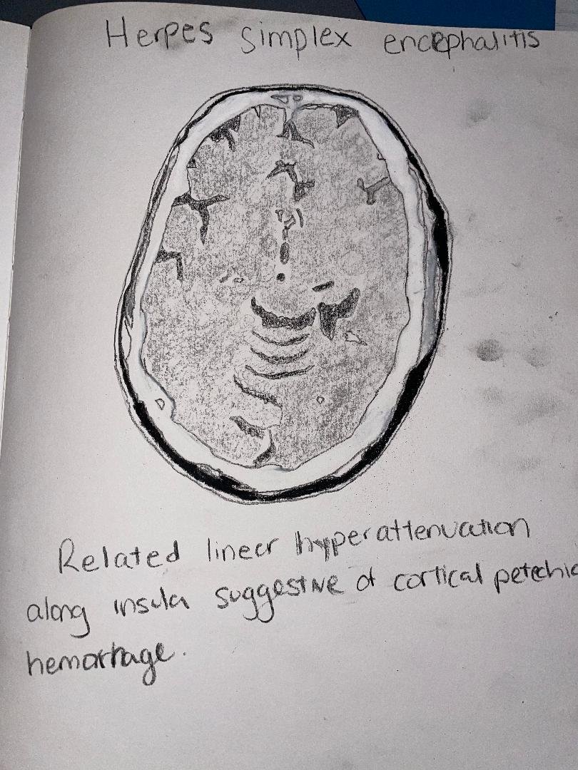 Herpes simplex encephalitis