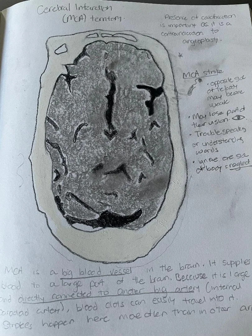 Middle cerebral artery (MCA) infarct