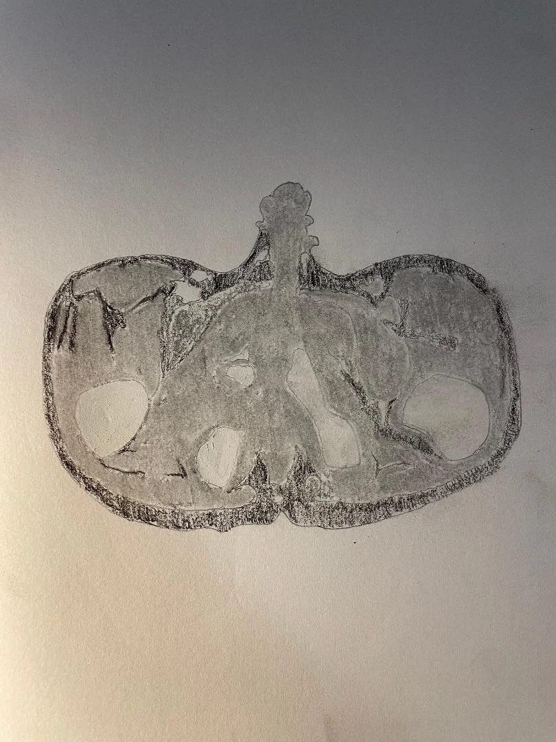 Osteomyelitis of the ischiopubic synchondrosis