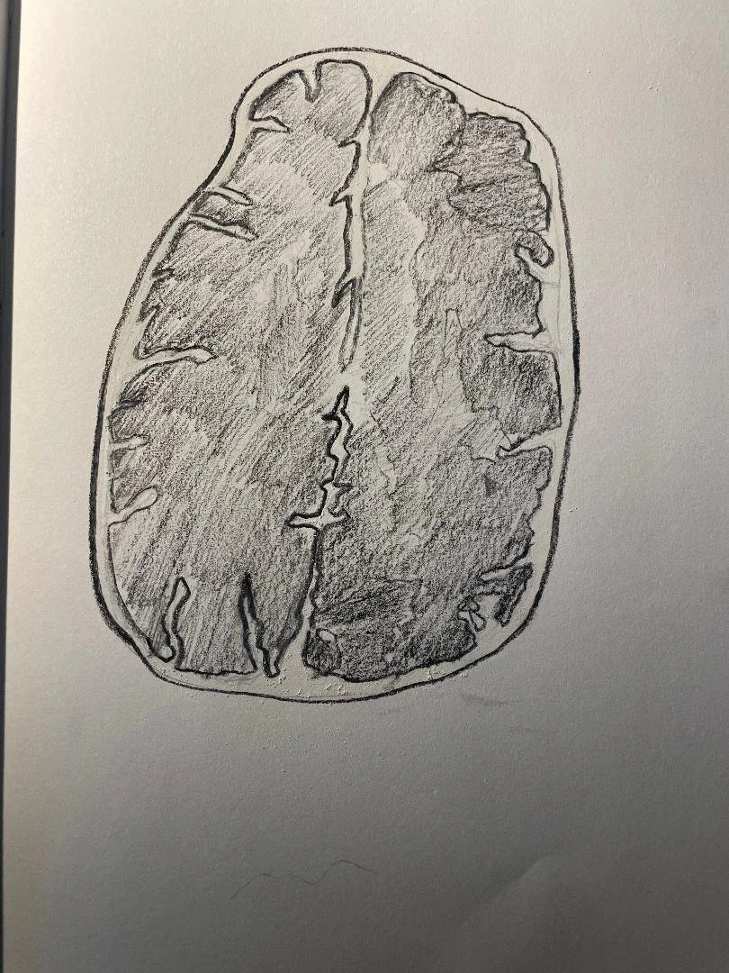 Focal cortical dysplasia