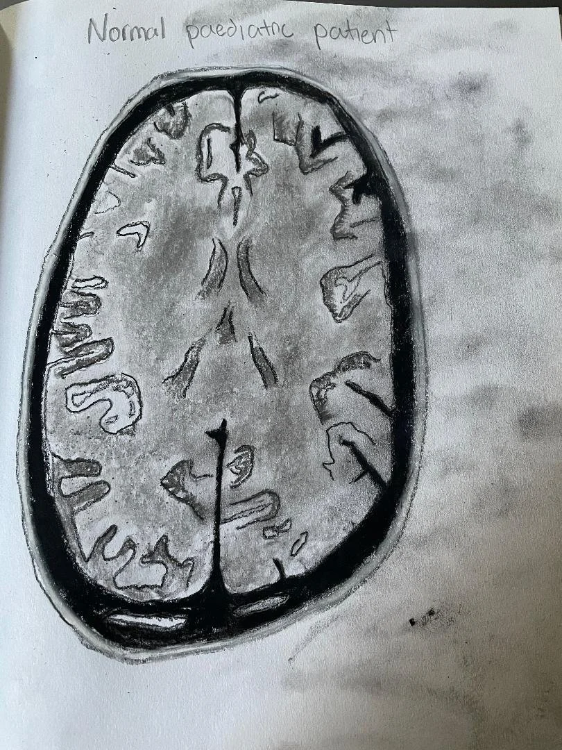 Normal MRI of the brain - 9-year-old