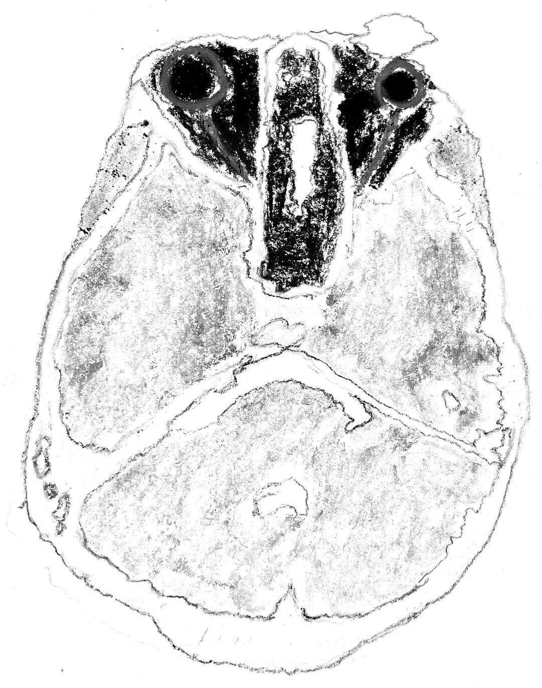 Supra-orbital haemangioma