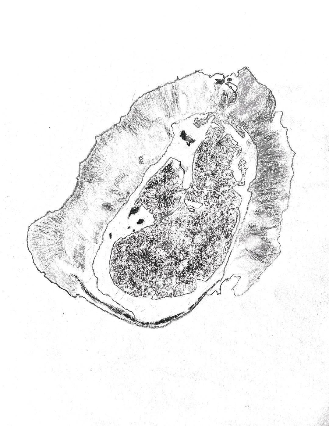 Myxofibrosarcoma: calvarial