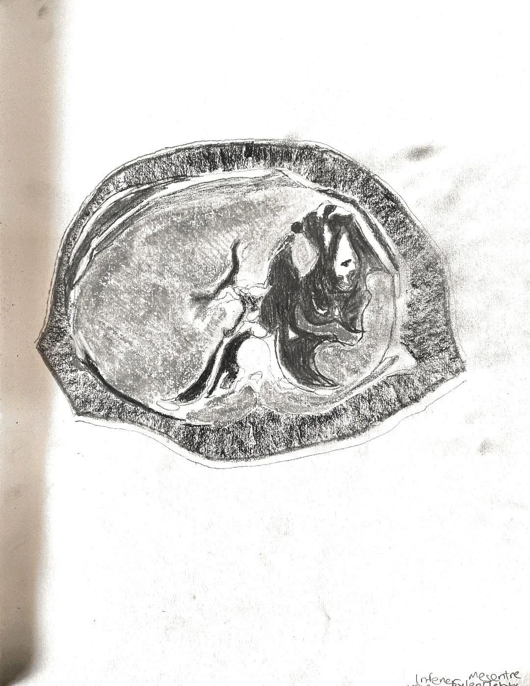 Telangiectatic osteosarcoma - skull