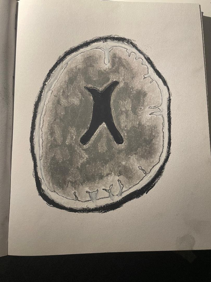 Middle cerebral artery infarction
