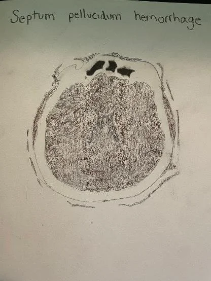 Septum pellucidum hemorrhage