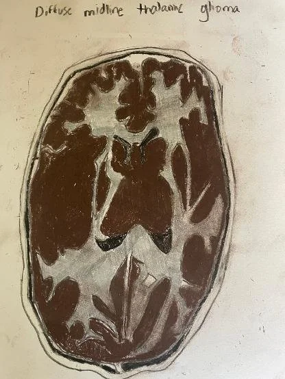 diffuse midline thalamic glioma