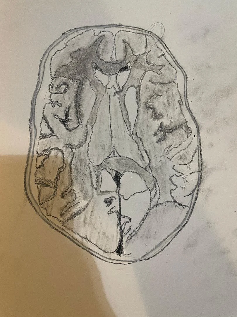 Parry Romberg syndrome