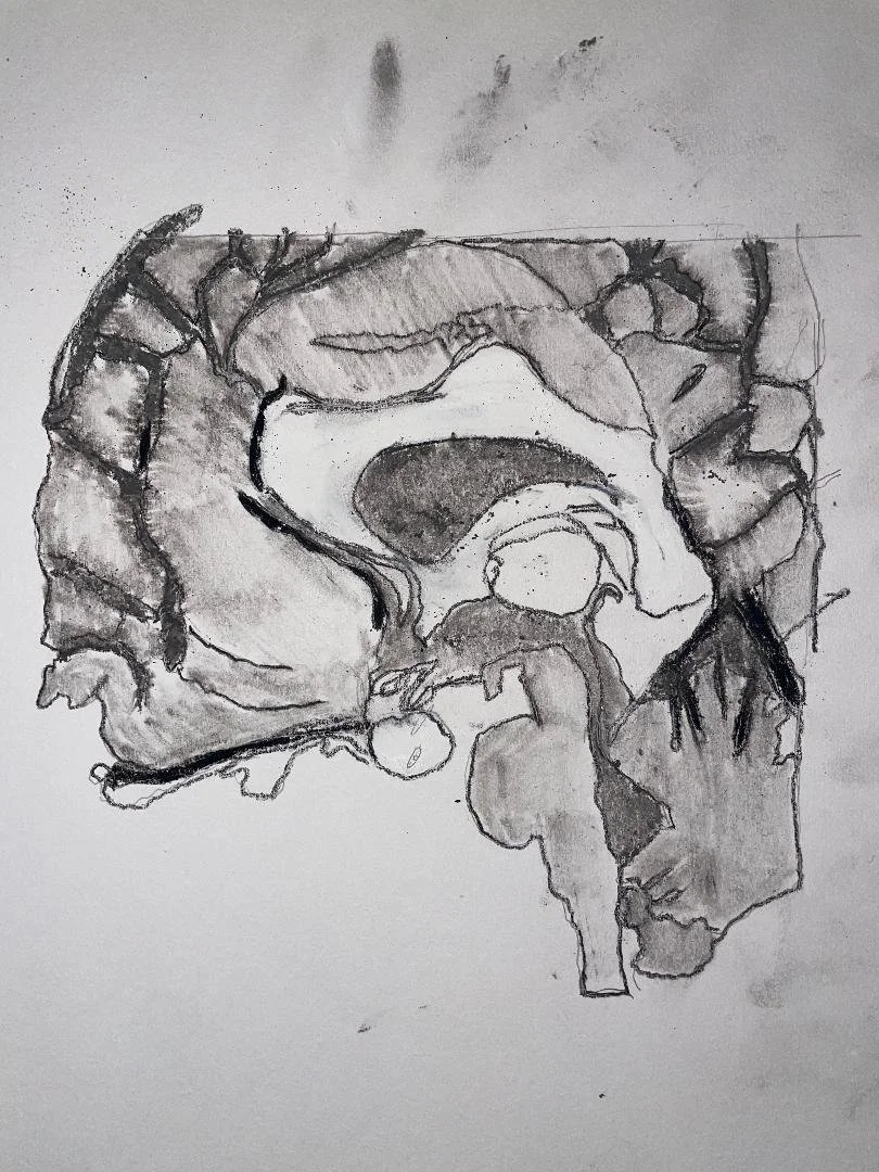 Pituitary microadenoma with chronic haemorrhage