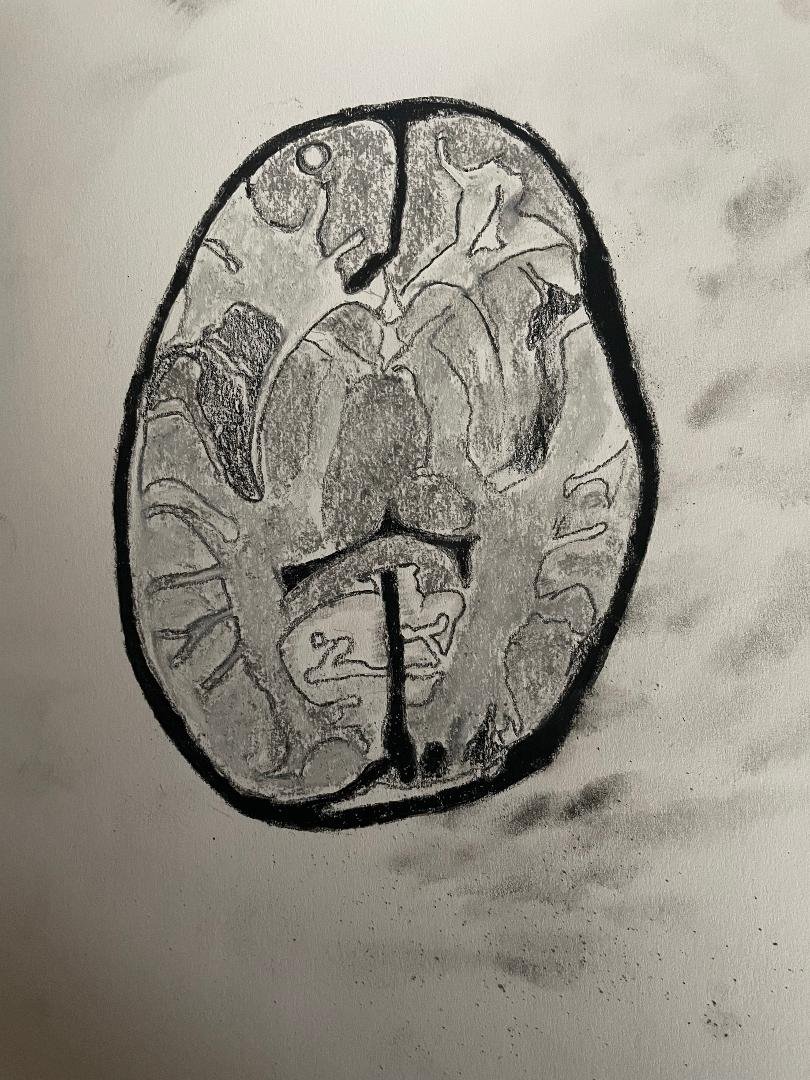 Neurocysticercosis with rapid interval regression on short-term follow-up MRI
