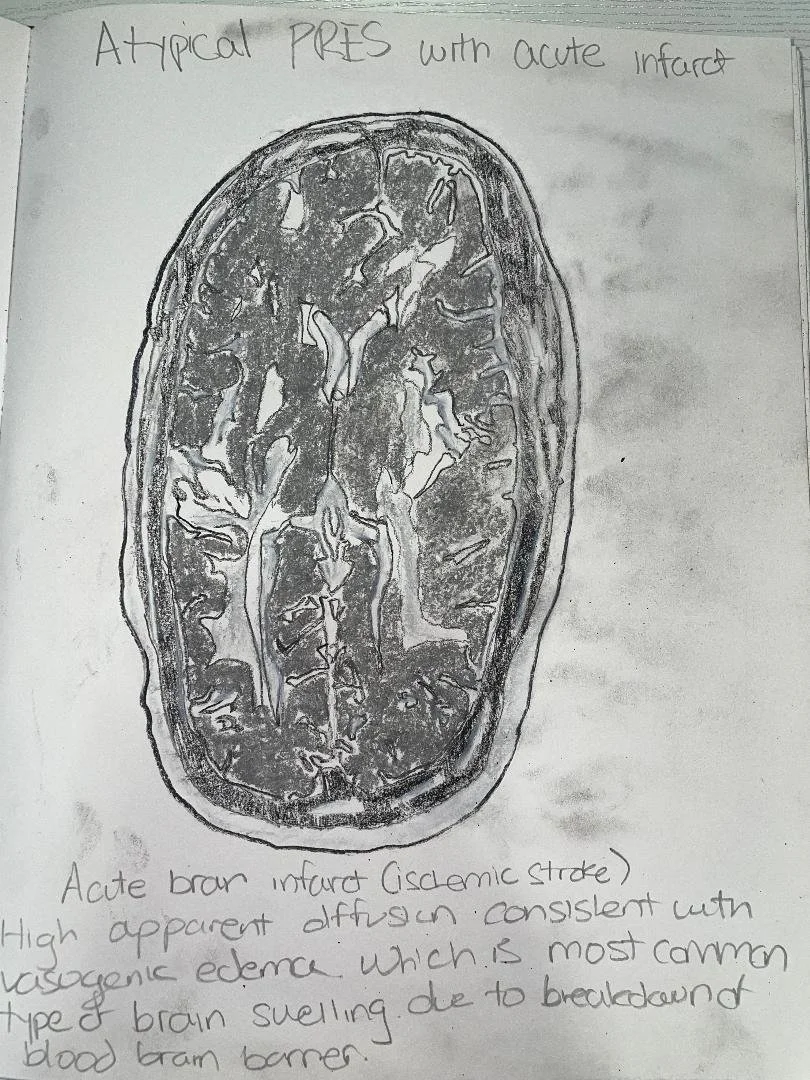 Atypical PRES with acute infarct
