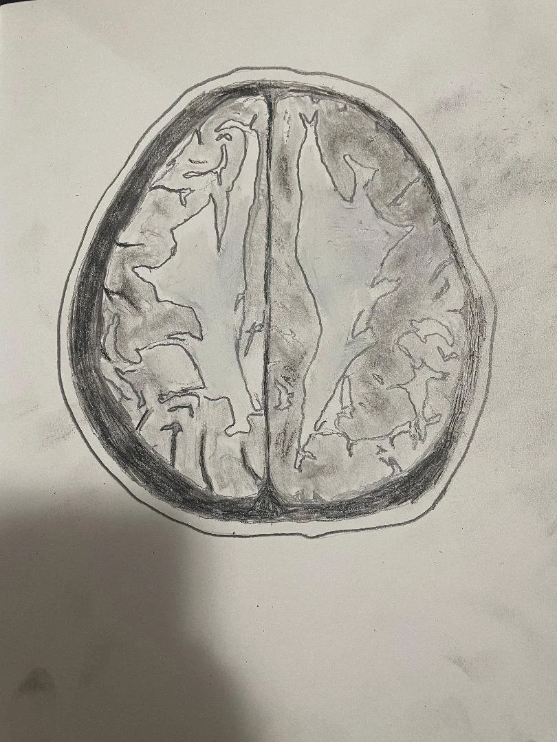 Toxic/inhalational leukoencephalopathy