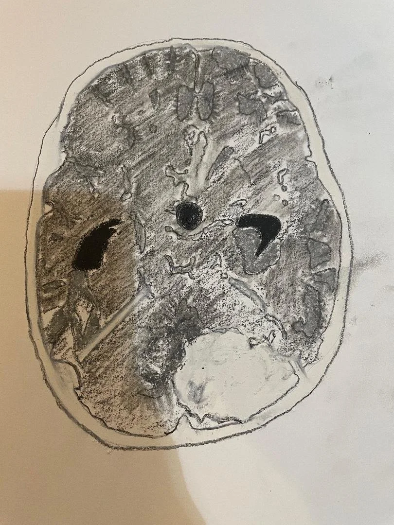 Medulloblastoma
