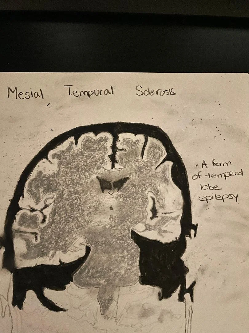 Mesial Temporal Sclerosis