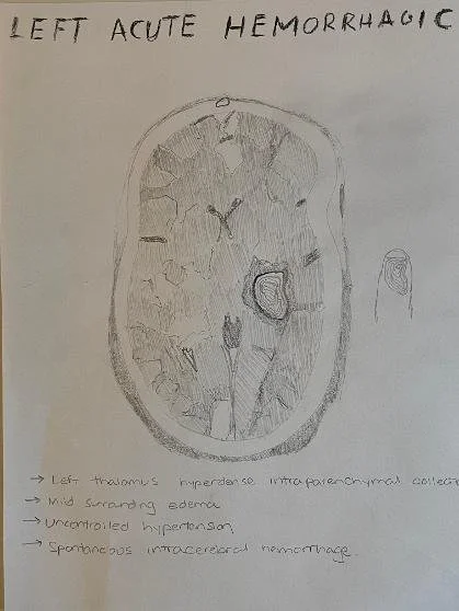 Left acute hemorrhagic