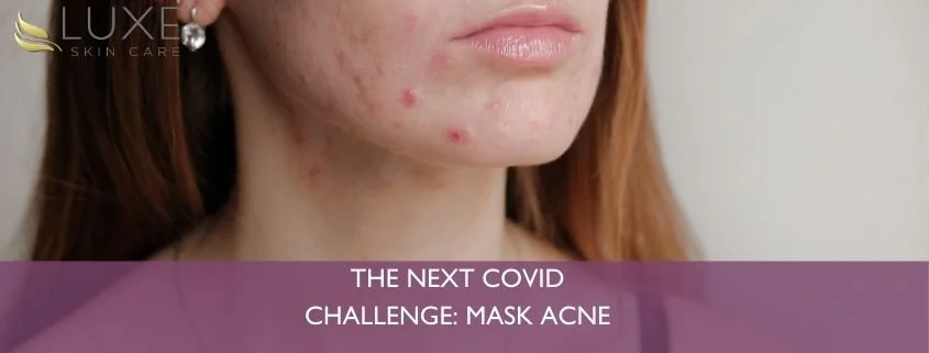 The Next COVID Challenge: Mask Acne