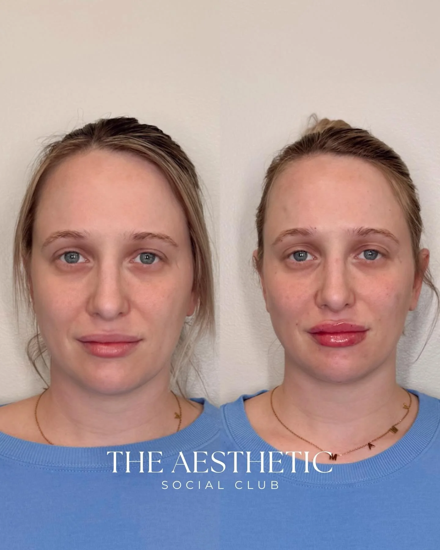 Facial balancing: part art, part science ✨

Thoughtful, strategic placement can enhance natural proportions and bring harmony to the face without looking overdone! The goal is subtle, balanced results that still look like you, just refreshed 💉

Chec