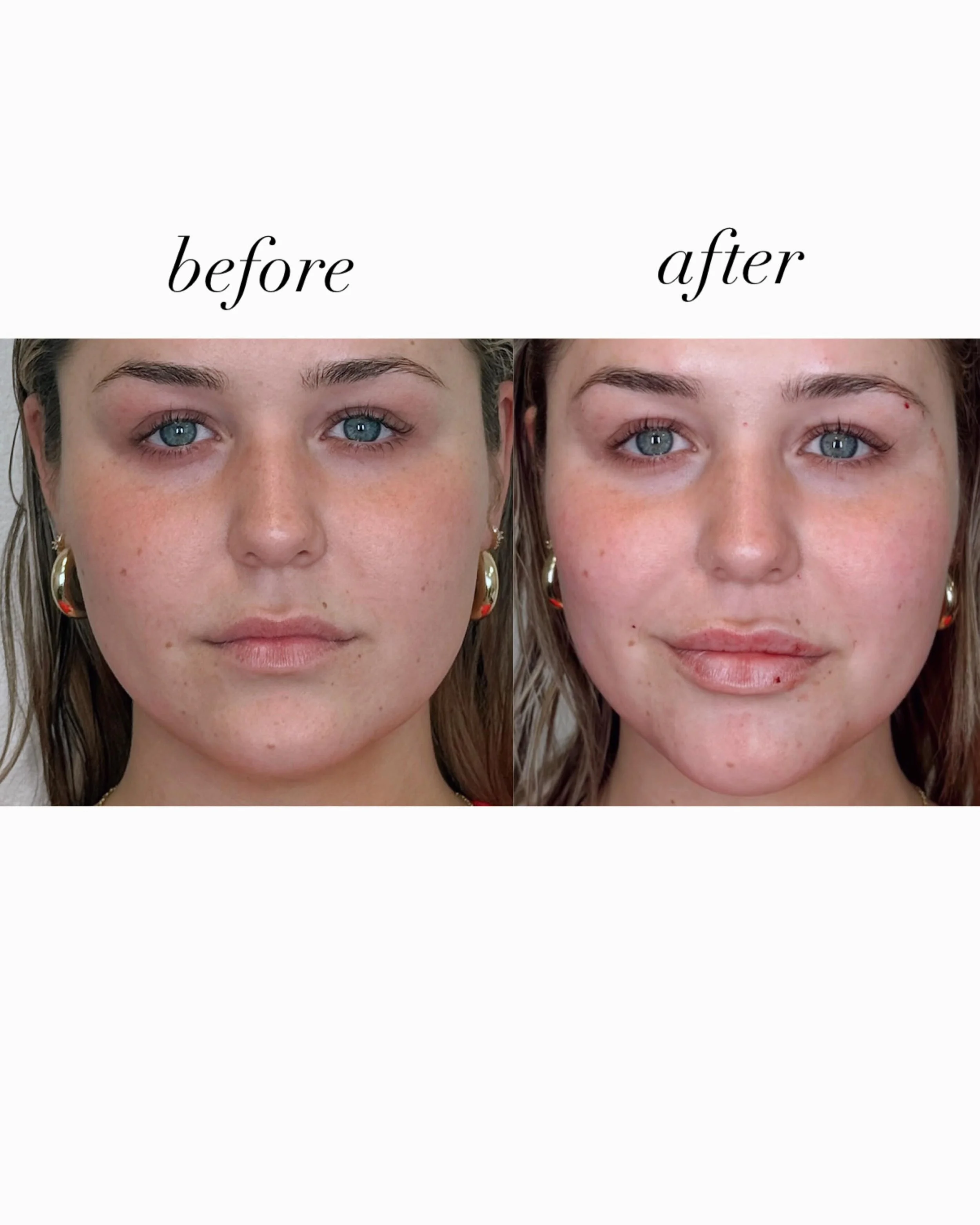 Love a good before and after ✨👏

Our founding client special is still LIVE 💫 book online now to get locked in pricing all throughout 2026, priority booking, and more 💉

📍Located inside Haus of Hudson - Timonium, MD

#aesthetics #beforeandafterlip