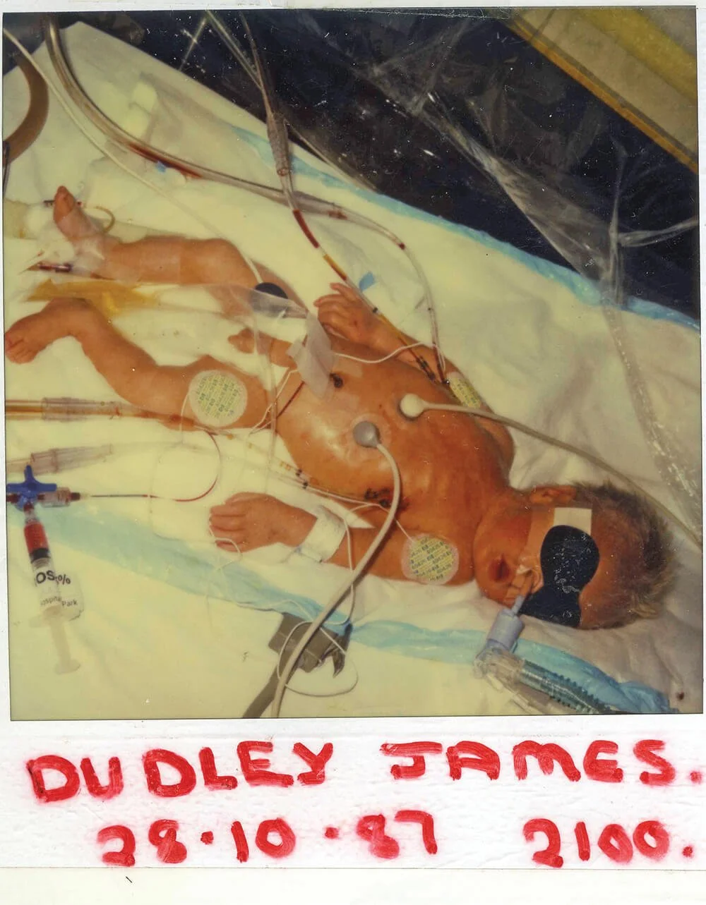 A newborn baby in a neonatal intensive care unit hooked up to medical devices and monitors, lying on a hospital bed with various wires and tubes attached.